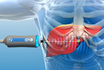 Fibroscan is a special form of scan for the liver