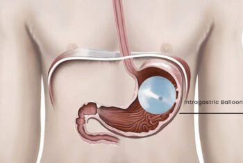 Intragastric Balloon in Dubai