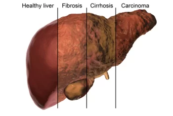 What is fatty liver