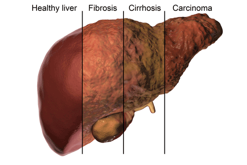 What is fatty liver