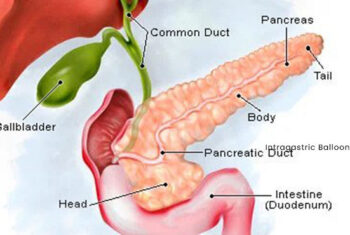 Pancreatic cysts are fluid filled cavities within the pancreas