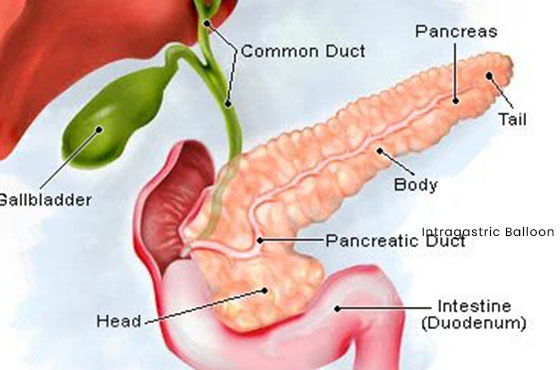 Pancreatic Cyst Treatment in Dubai