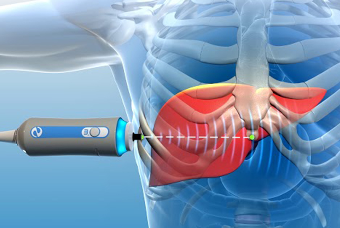 Fibroscan is a special form of scan for the liver