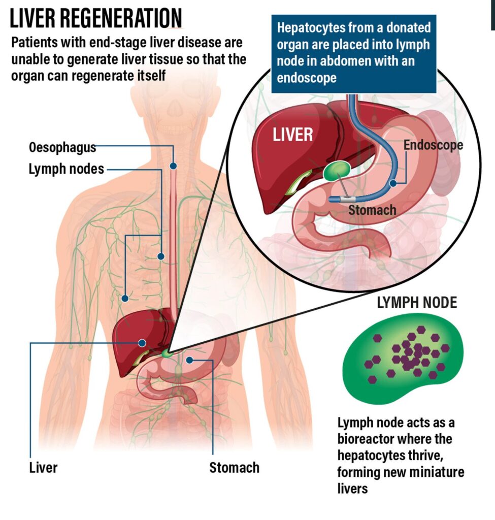 Liver Transplantation is the standard of care and can be life saving for patients with liver cirrhosis, liver failure and liver cancer.