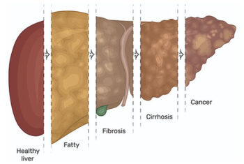 Progression of Liver Disease Dubai