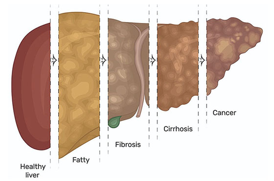 Progression of Liver Disease Dubai