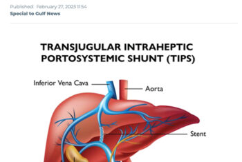 First-ever TIPS procedure performed at King’s College Hospital London, Dubai