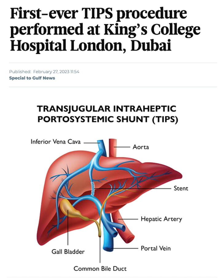 First-ever TIPS procedure performed at King’s College Hospital London, Dubai
