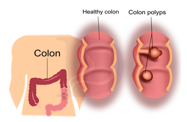 What are colon polyps?