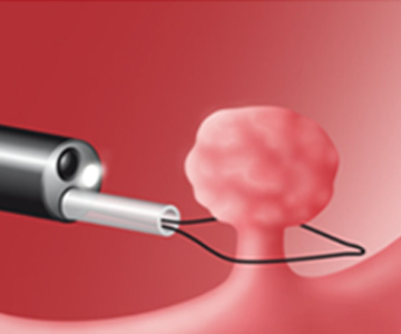 Wire snare is deployed through colonoscope