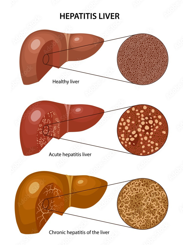 Hepatitis Liver