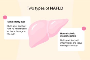 Types of fatty liver