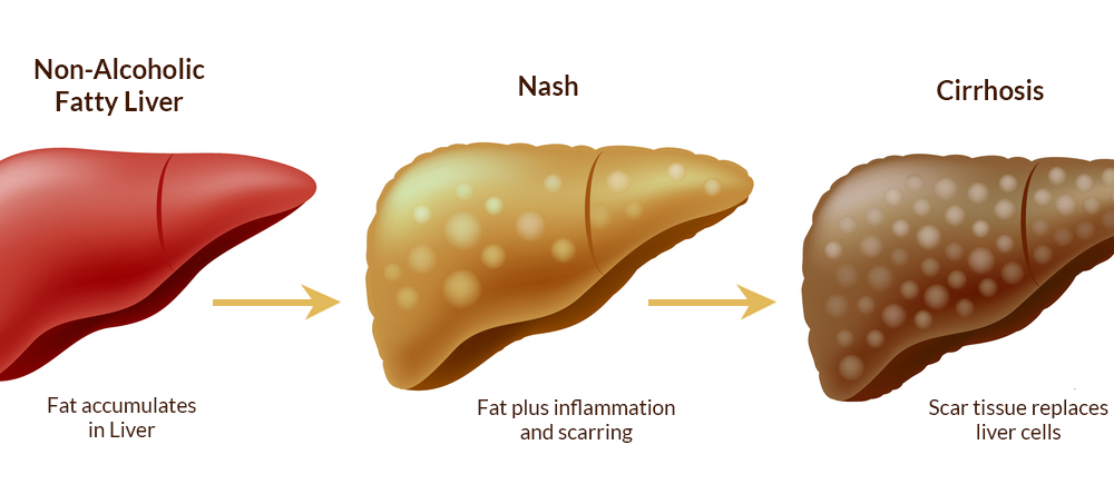 What is NASH related Cirrhosis