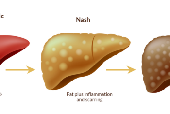 What is NASH related Cirrhosis