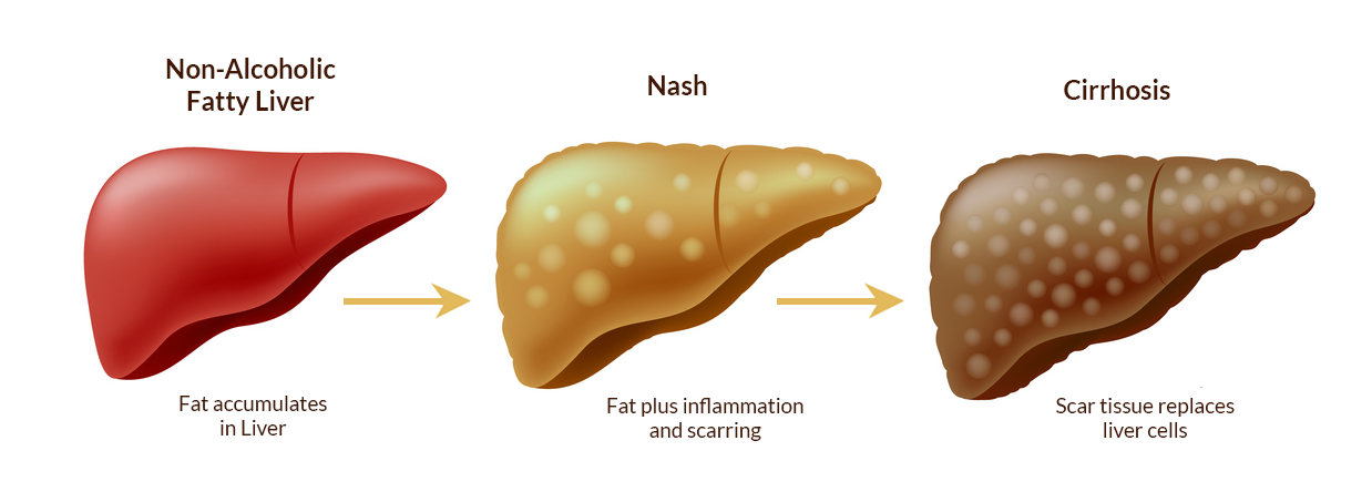 What is NASH related Cirrhosis