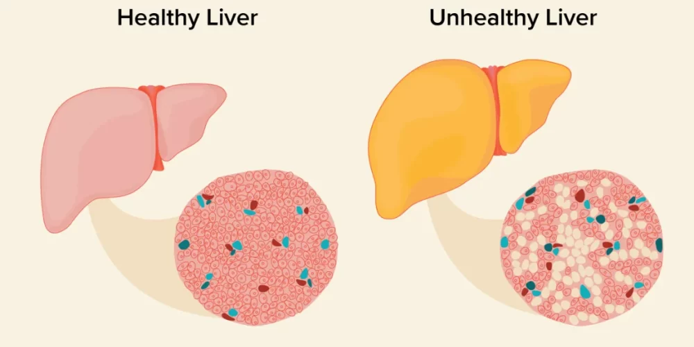 What monitoring do patients with simple fatty liver need