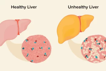 What monitoring do patients with simple fatty liver need