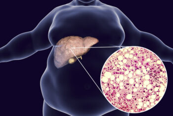 Who is at higher risk for developing NASH and progressive liver disease