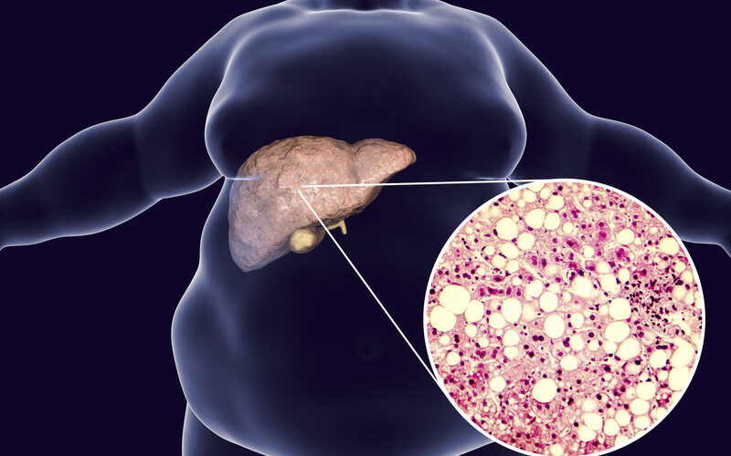 Who is at higher risk for developing NASH and progressive liver disease