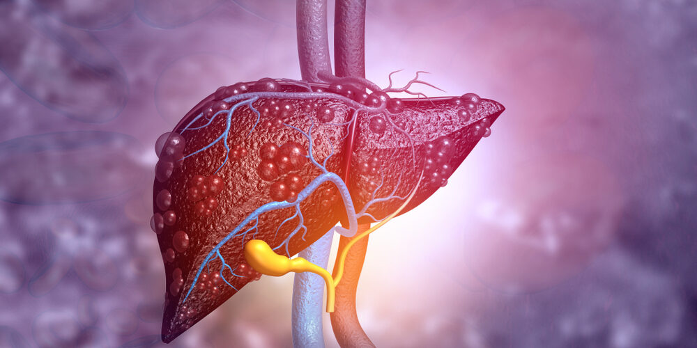 differentiate between simple fatty liver and NASH