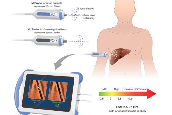 How does Fibroscan measure liver stiffness?