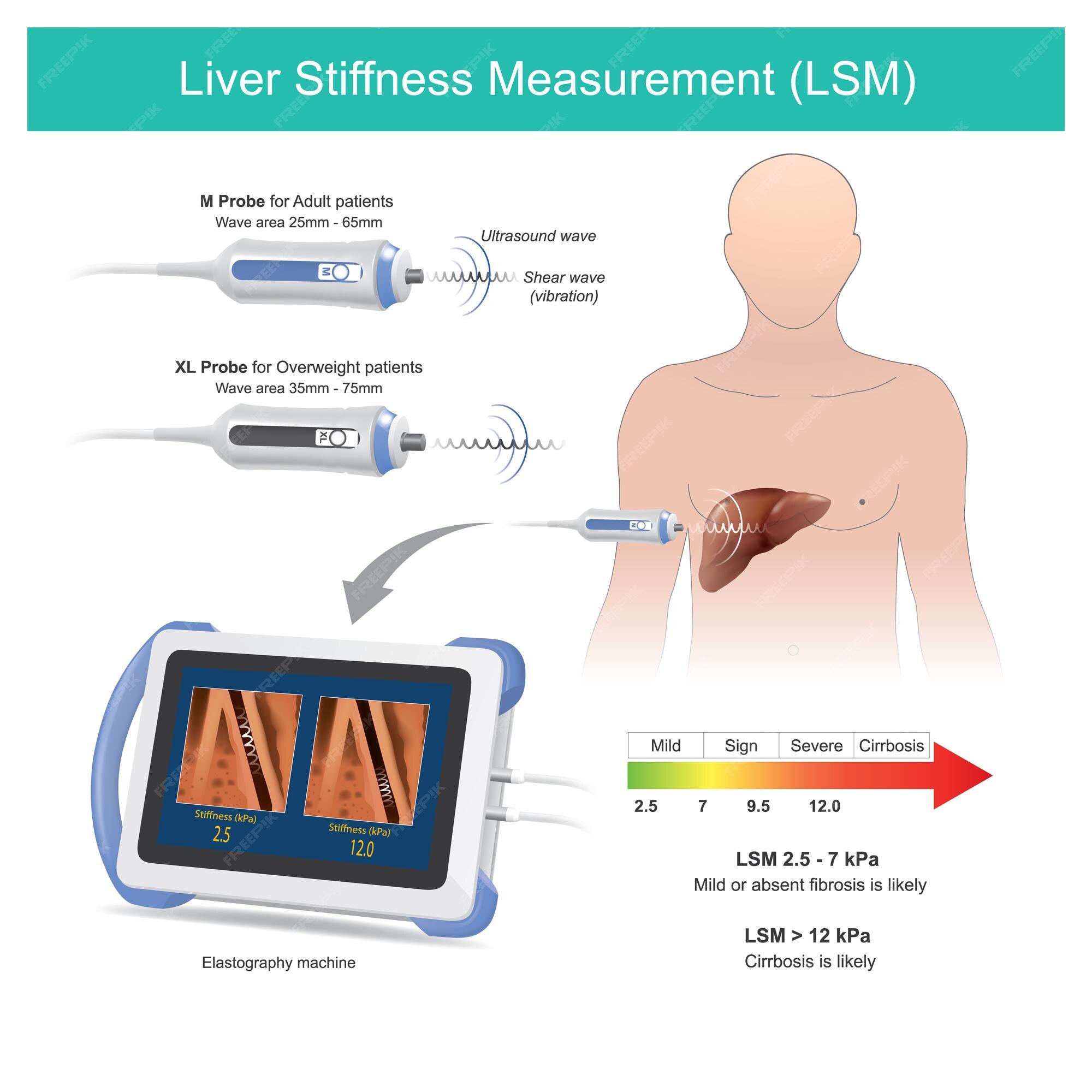 How does Fibroscan measure liver stiffness?