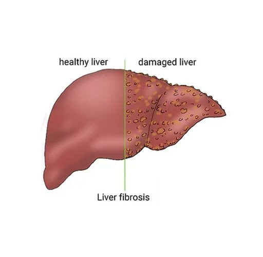 What is Liver fibrosis?