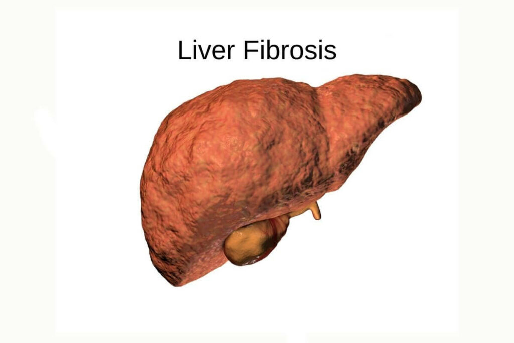 What is Liver fibrosis?
