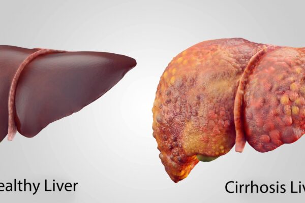 Which diseases cause liver fibrosis and cirrhosis?