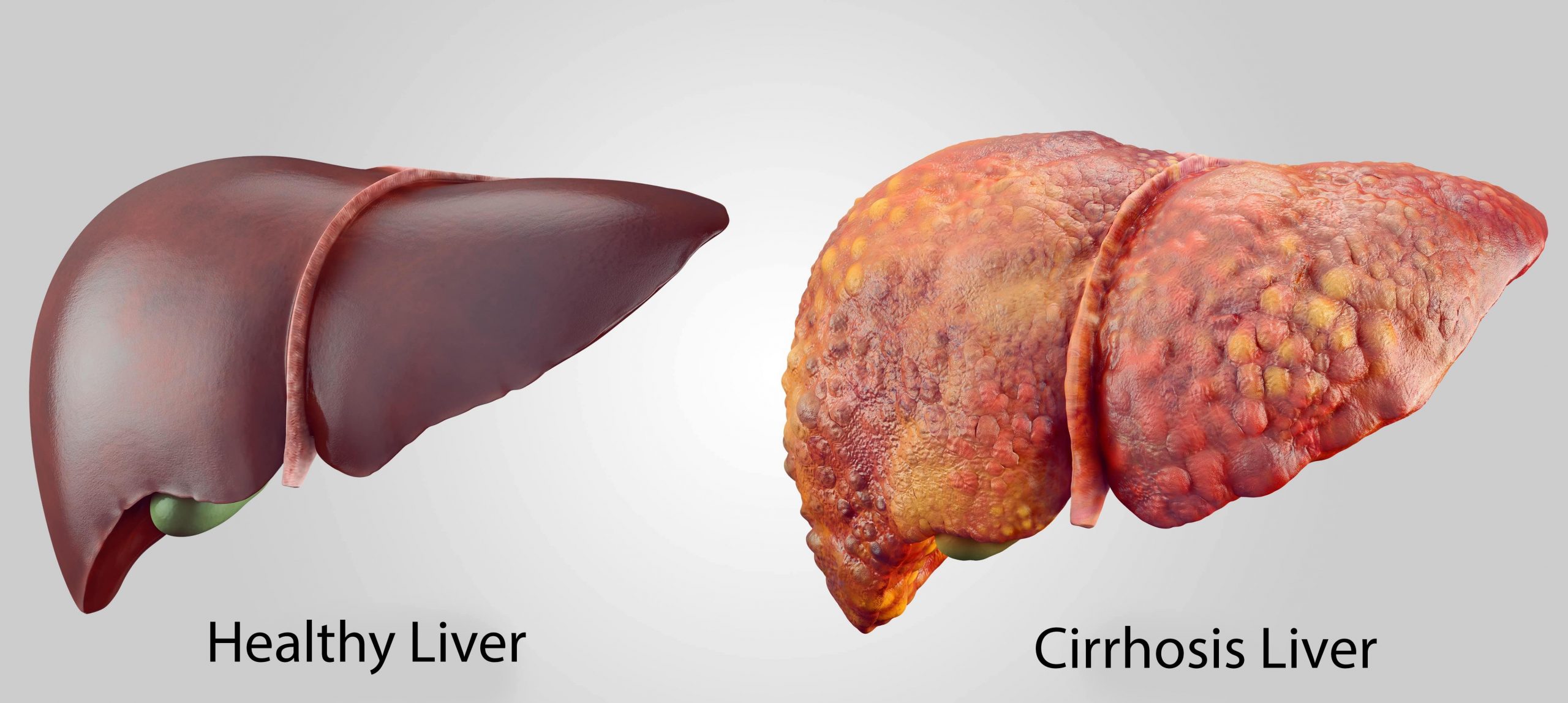 Which diseases cause liver fibrosis and cirrhosis?