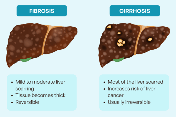 Why is it important to know if there is liver fibrosis?