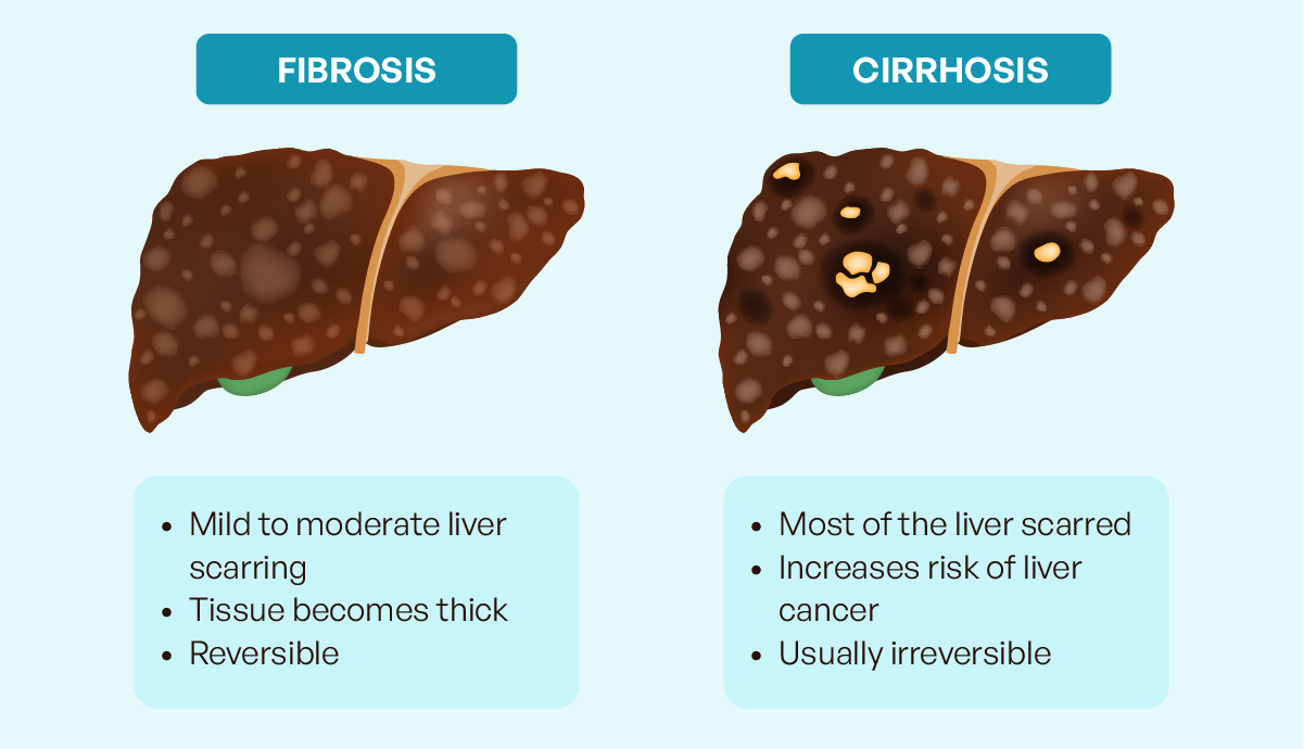 Why is it important to know if there is liver fibrosis?