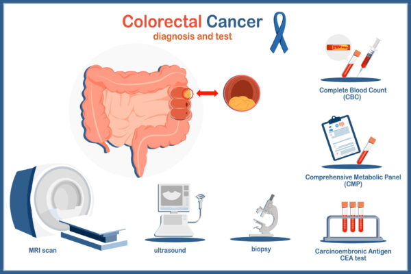 How is screening done for colon cancer?