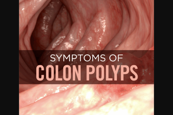 What are the symptoms of colon polyps