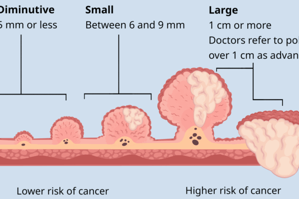 What are the types of colon polyps?