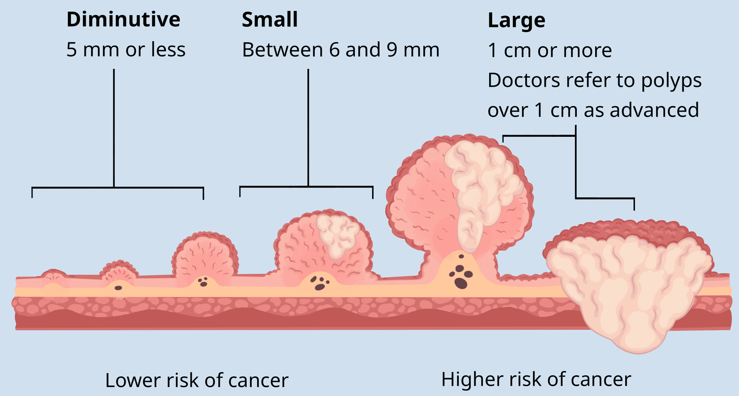 What are the types of colon polyps?