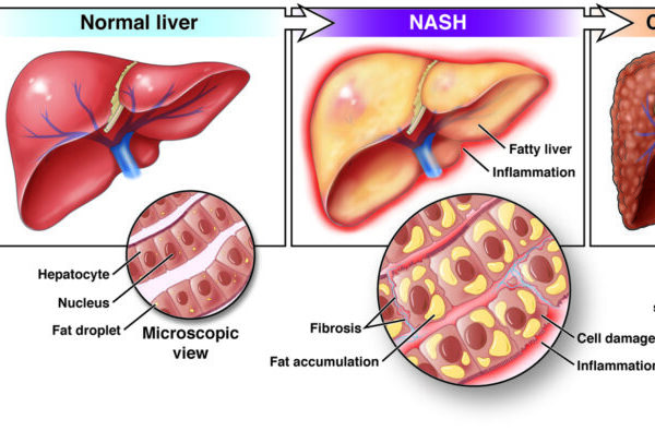 What is NASH related Cirrhosis