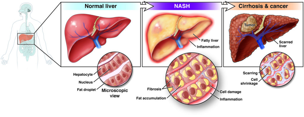 What is NASH related Cirrhosis