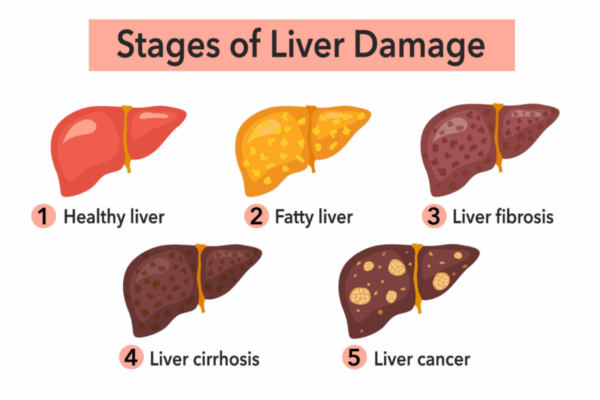 What is fatty liver
