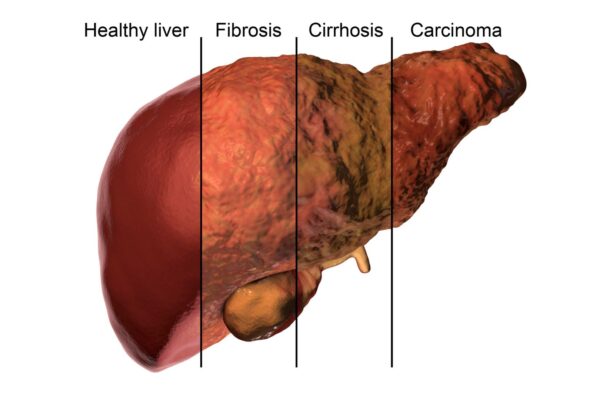 Fatty Liver Disease Consultant in Dubai