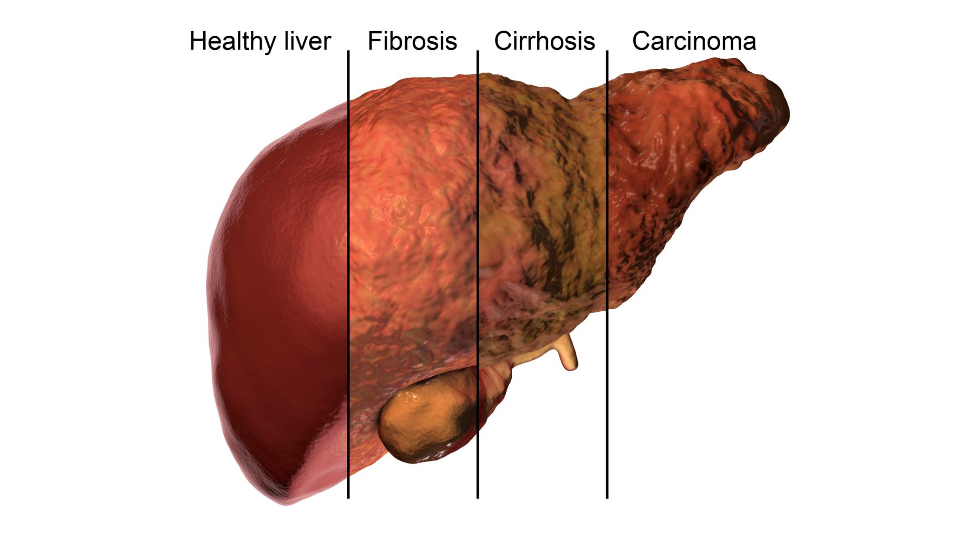 Fatty Liver Disease Consultant in Dubai