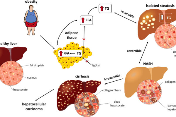 Who is at higher risk for developing NASH and progressive liver disease
