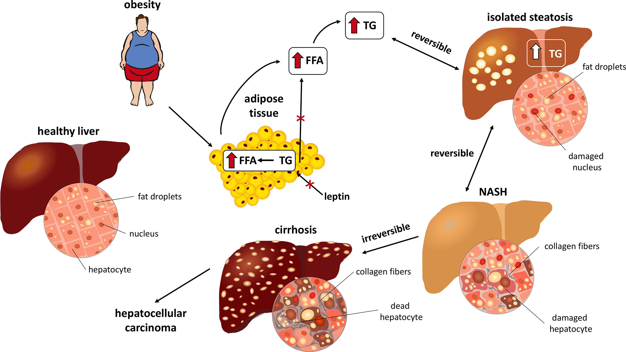 Who is at higher risk for developing NASH and progressive liver disease