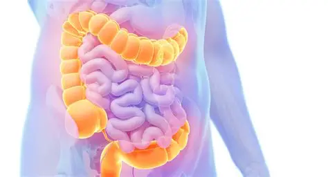 Colon Polys and Colon Cancer