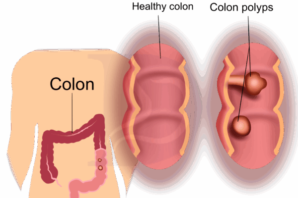 Colon Polys and Colon Cancer