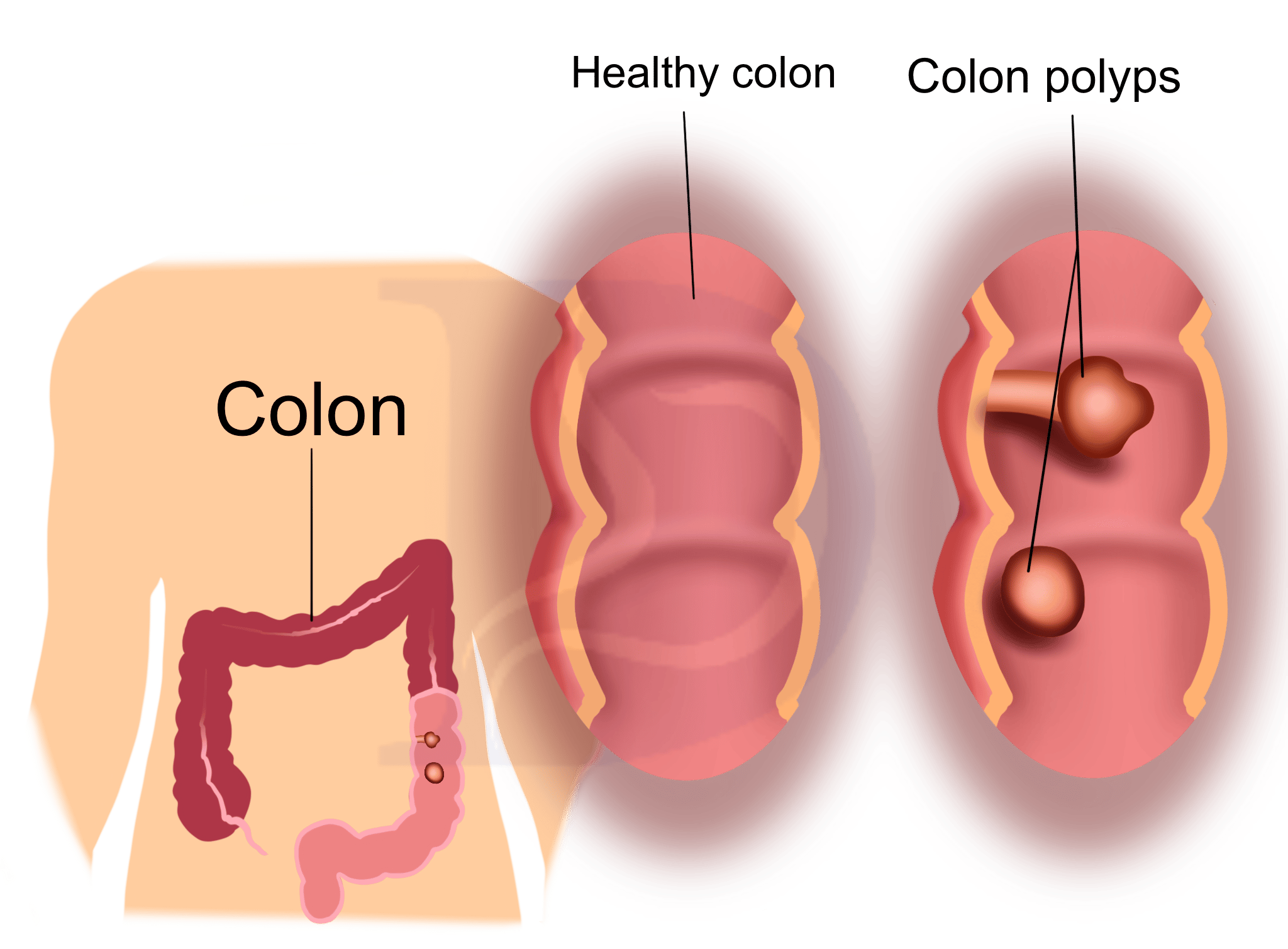 How do colon polyps progress to colon cancer?