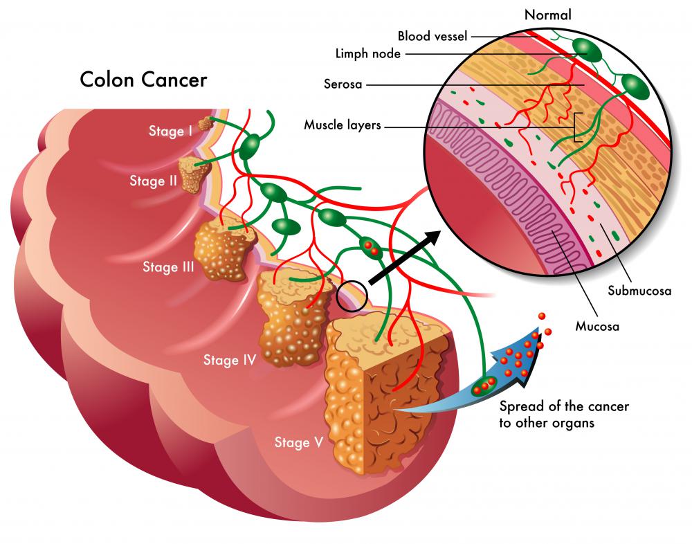 What are colon polyps?
