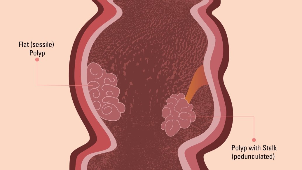 Who is at risk of developing colon polyps?
